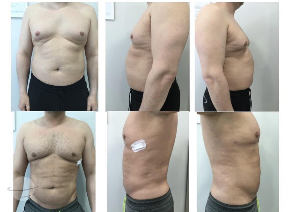 Risultato prima e dopo per Liposuzione — Kardiolita