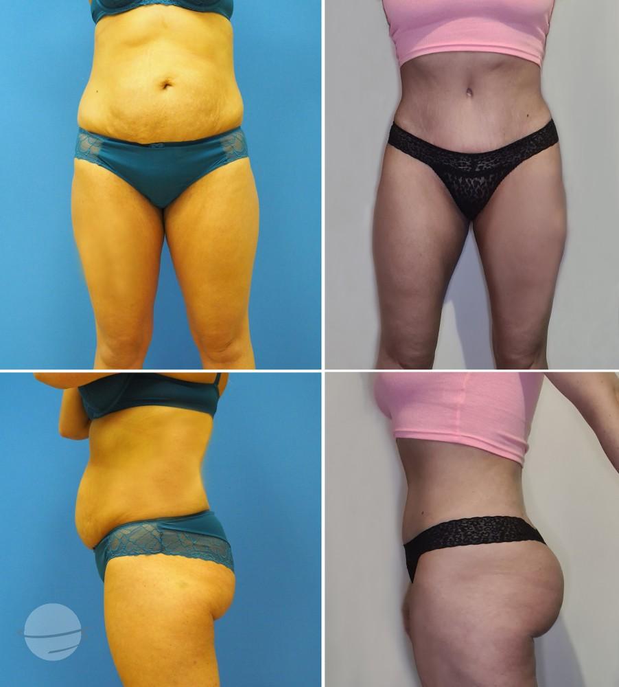 Tummy tuck, thigh lipo