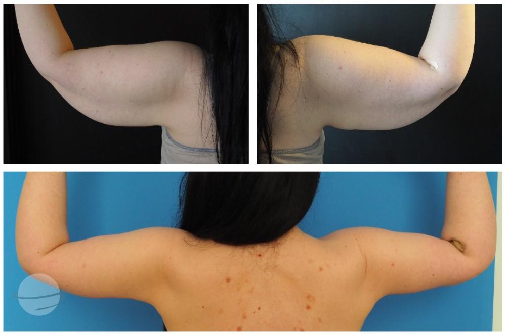 Resultado de antes y después para Lifting de brazos — Kardiolita