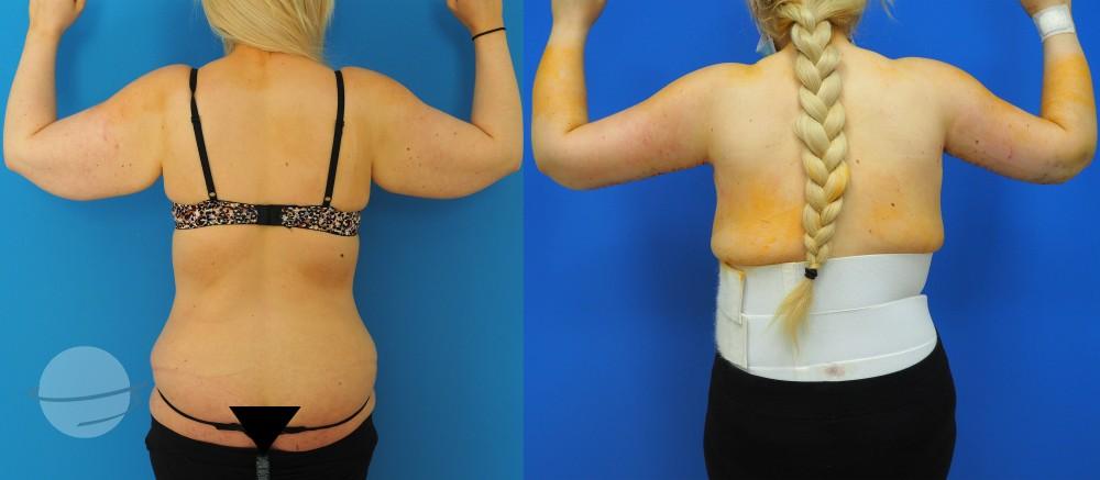 Resultado de antes y después para Lifting de brazos — Kardiolita