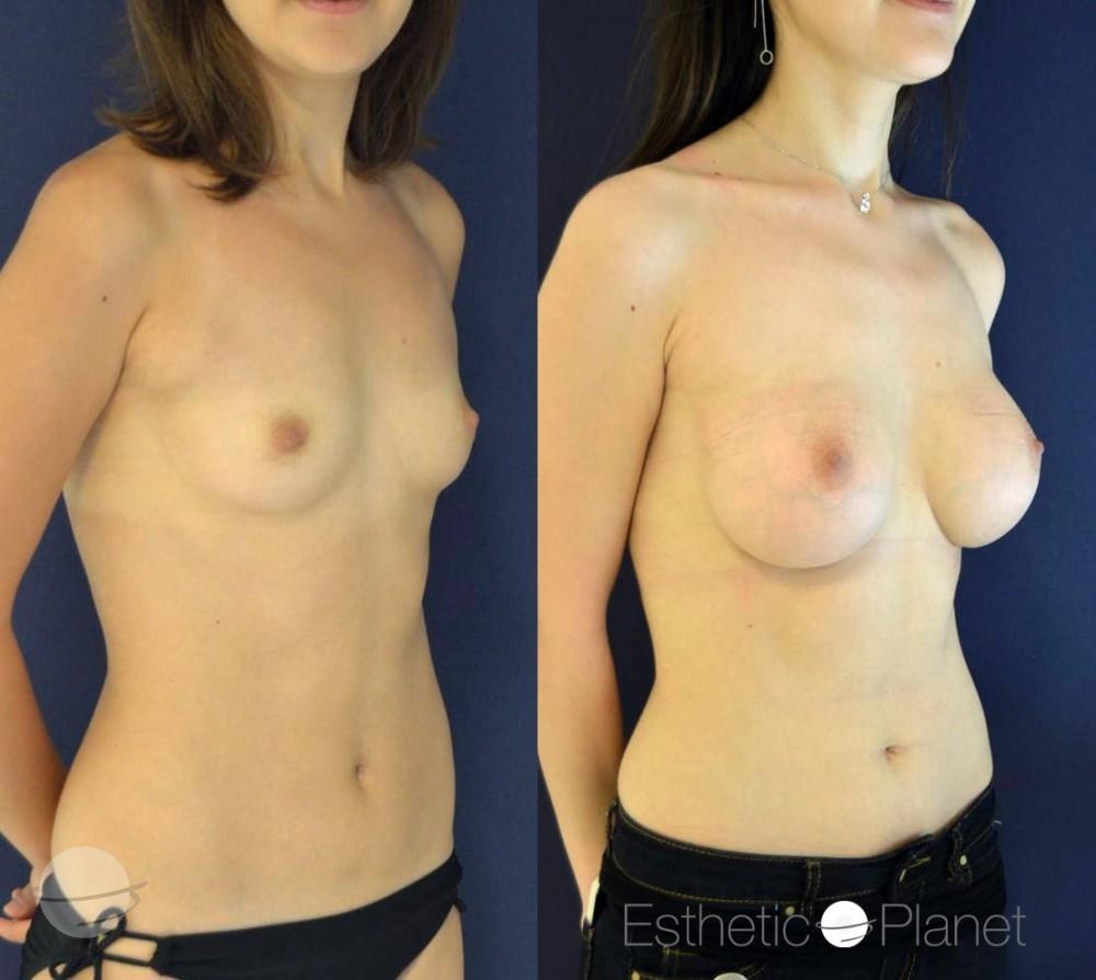 Breast augmentation by Dr Ergin Er 