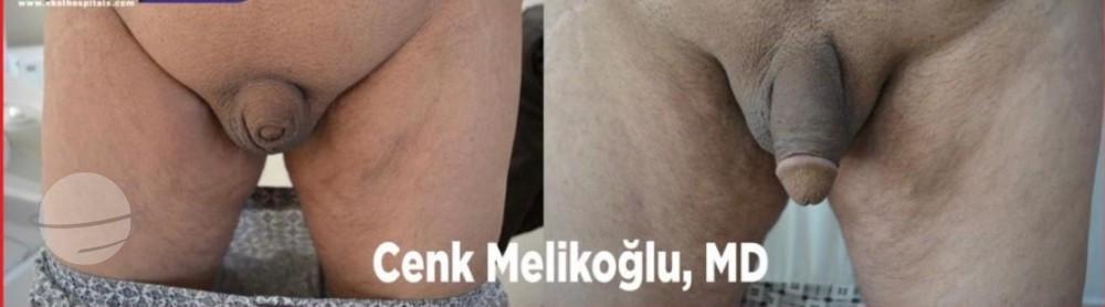 Risultato prima e dopo per Penoplastica — Ekol Hastanesi