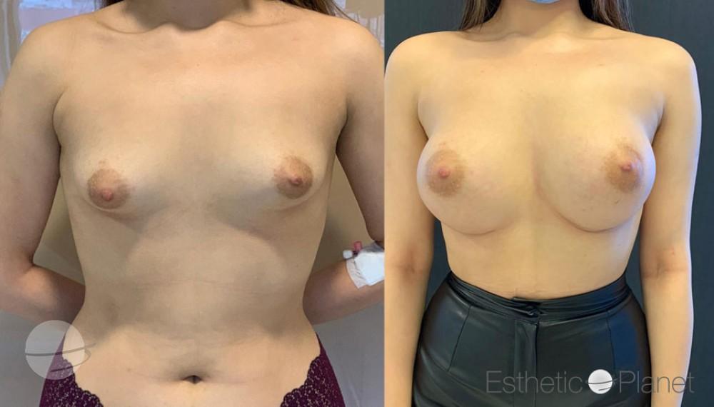 Breast augmentation by Dr Ergin Er 