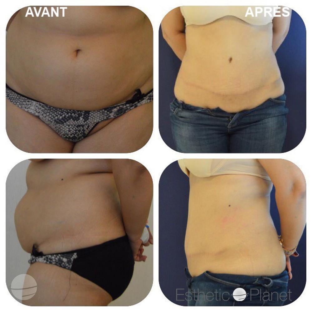 abdominoplastie1-min