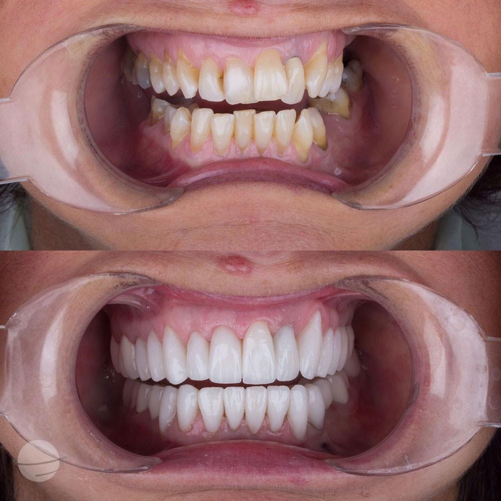 Veneers by Dentaglobal 