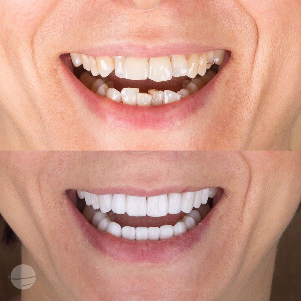 Veneers by Dentaglobal 