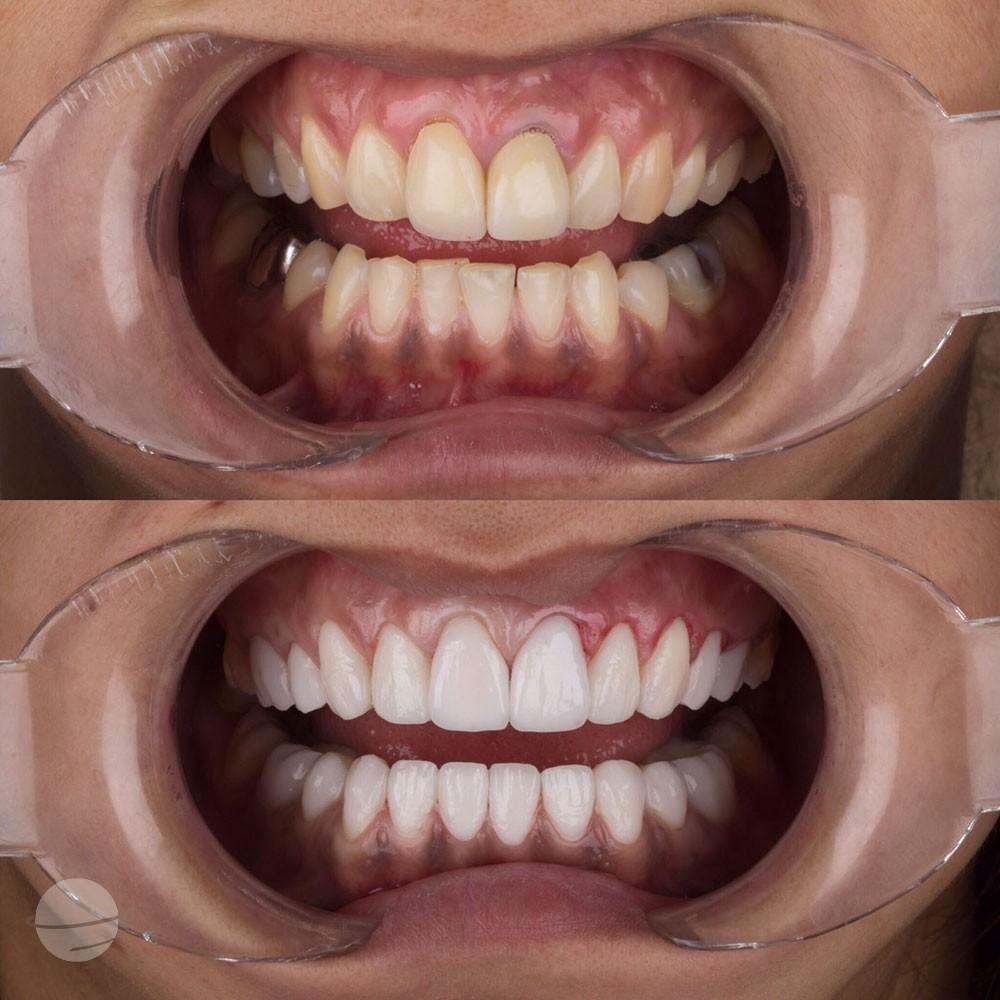 Veneers by Dentaglobal 
