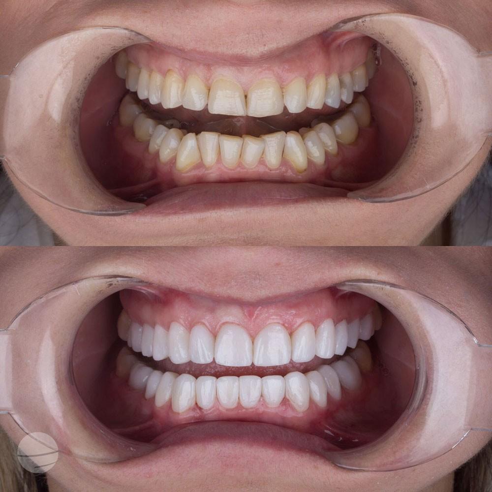 Veneers by Dentaglobal 