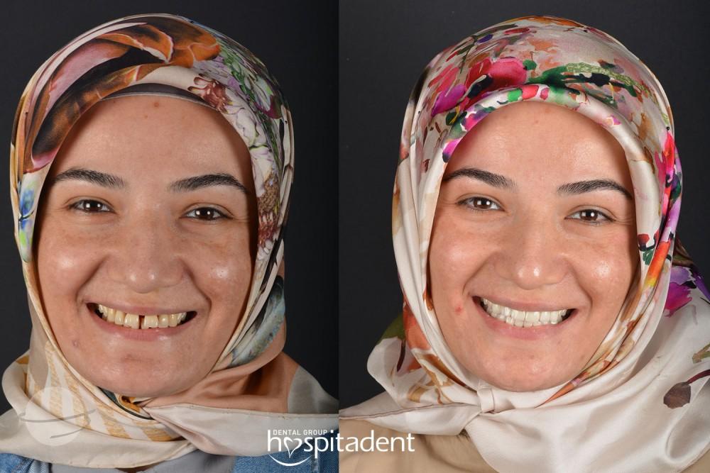 Facettes Dentaires // Dental Veneers