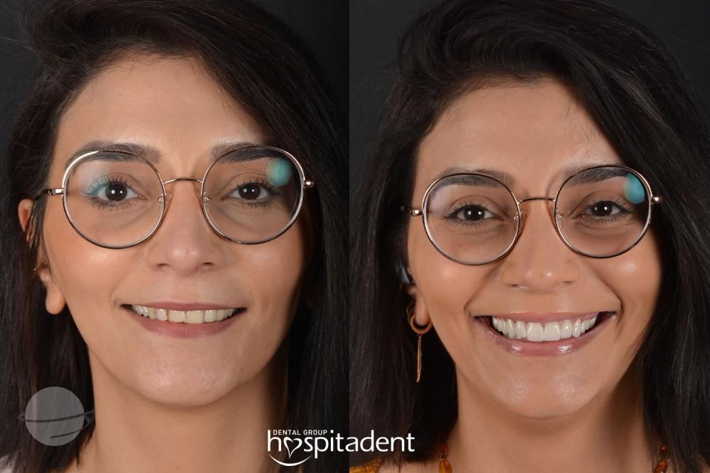 Facettes Dentaires // Dental Veneers