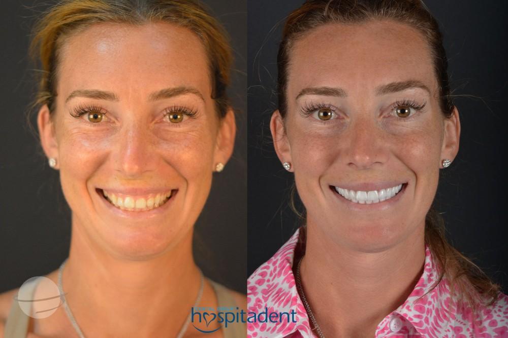 Facettes Dentaires // Dental Veneers