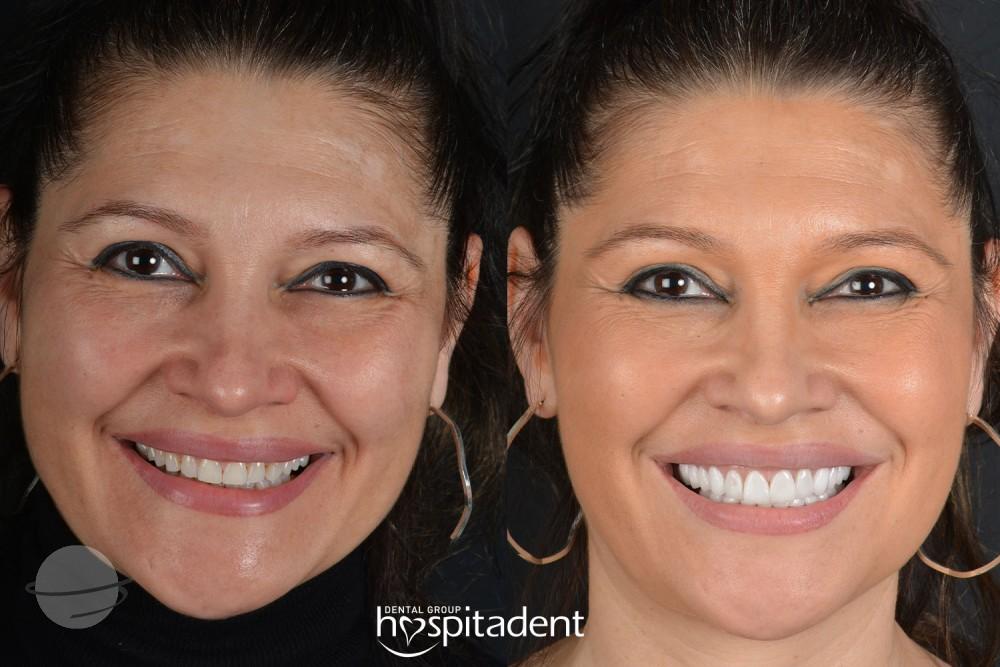 Facettes Dentaires // Dental Veneers