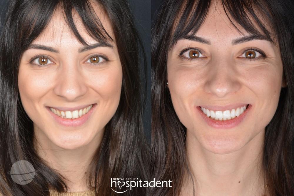 Risultato prima e dopo per Faccette dentali — Hospitadent