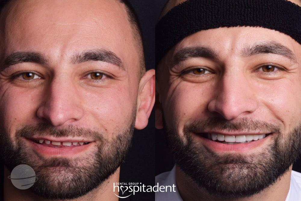 Facettes Dentaires // Dental Veneers