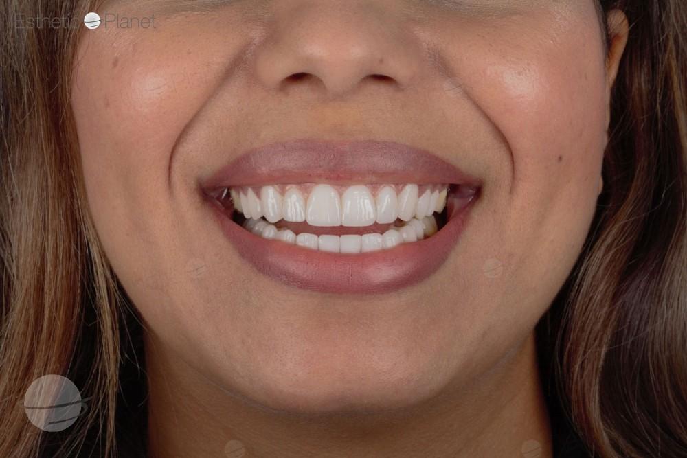 Veneers by Dentaglobal 