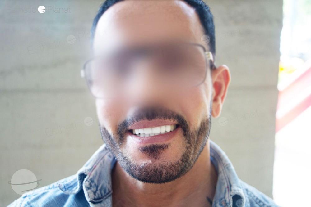 Veneers by Dentaglobal 