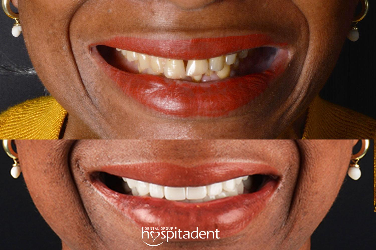 Dental Zirconium crown7