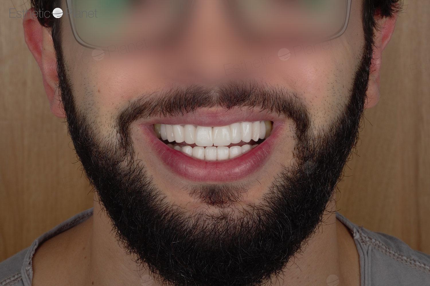 Veneers by Dentaglobal 