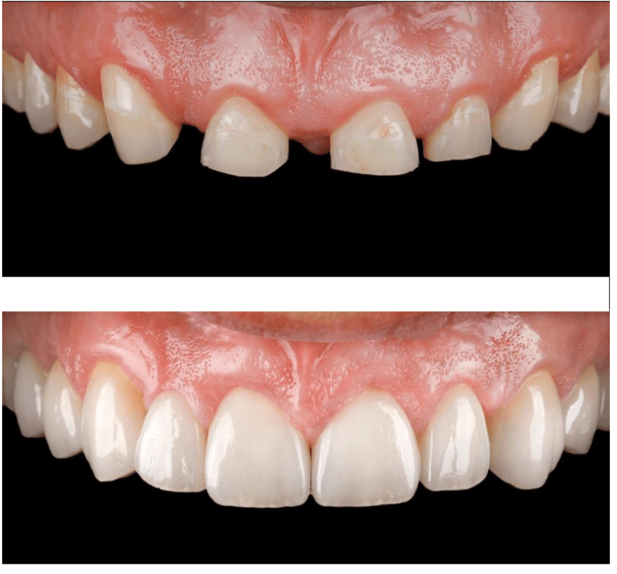 12-couronnes-ceramiques