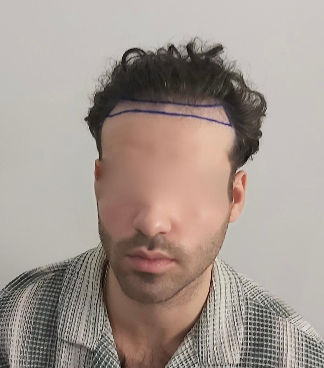  Dr Sofiene Ouerghi before : after10