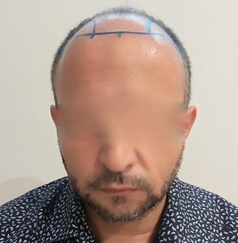  Dr Sofiene Ouerghi before : after12