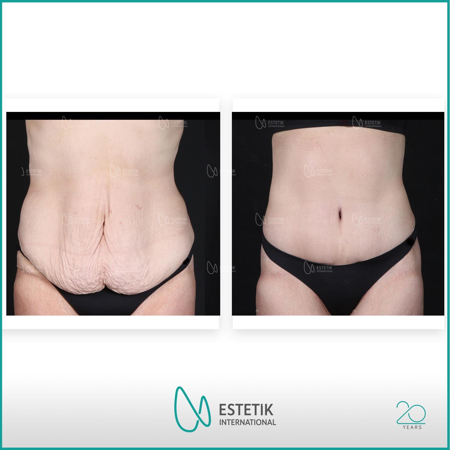 Estetik international results Tummy tuck