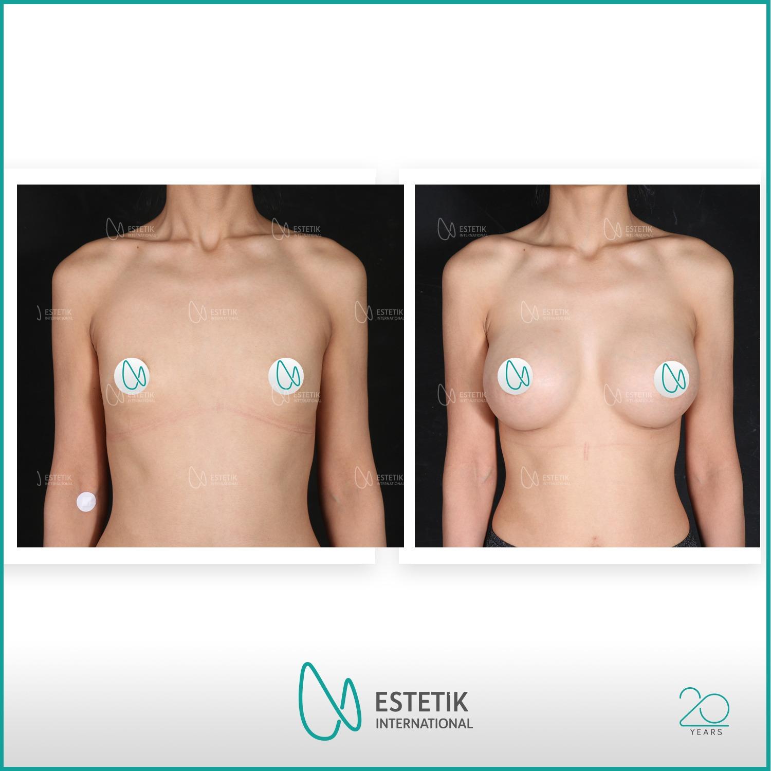 Estetik international results Breast Augmentation 
