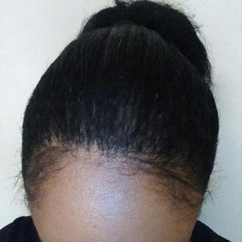 main-greffe-cheveux-afro