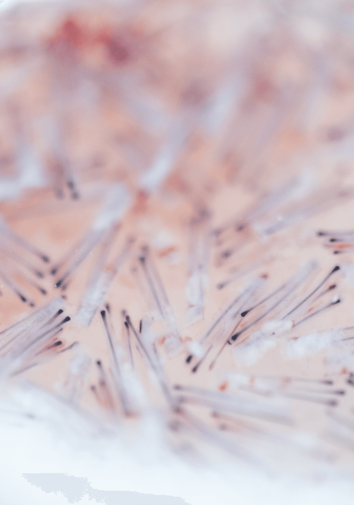 Dr Bruno Ferreira Hair Transplant in Porto