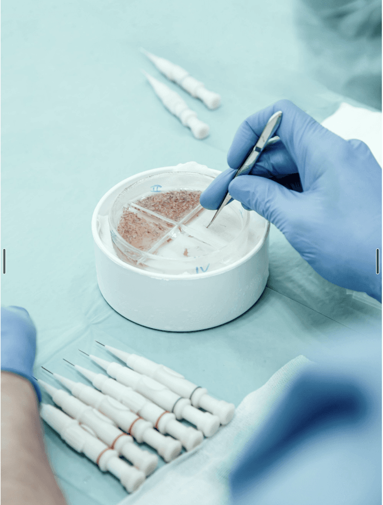 Dr Bruno Ferreira Hair Transplant in Porto