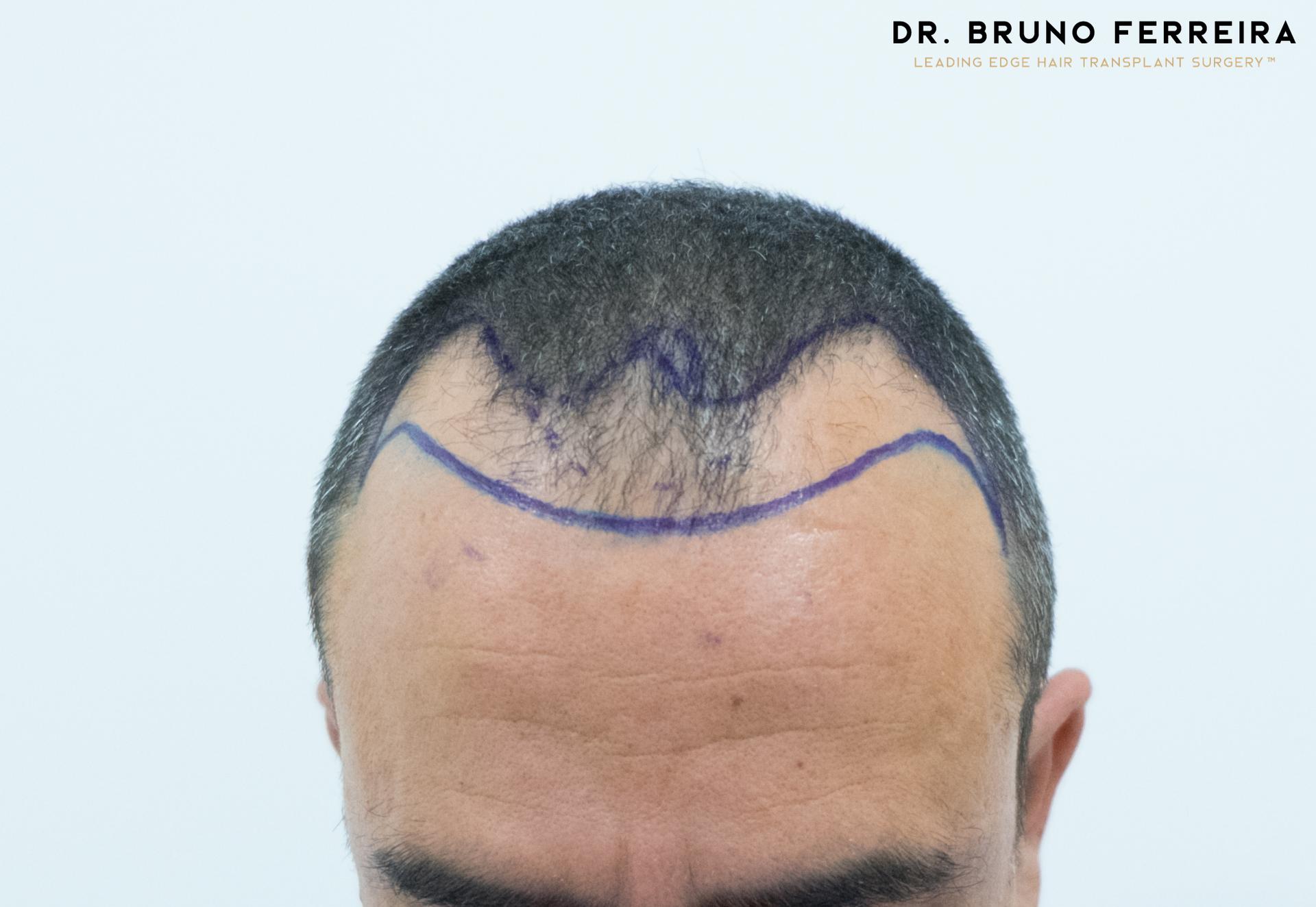 Dr Bruno Ferreira FUE before