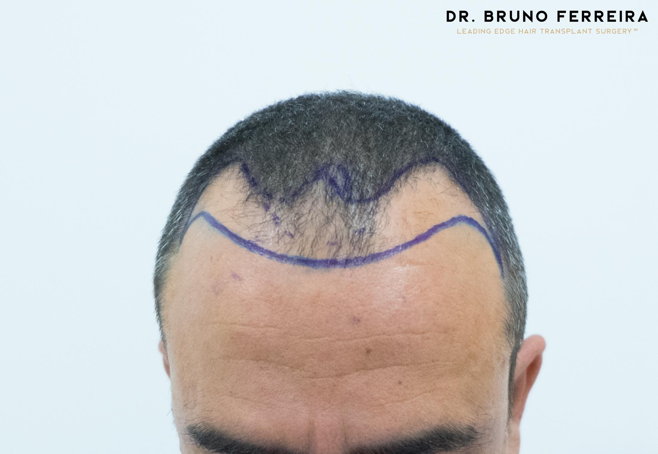 Dr Bruno Ferreira FUE before