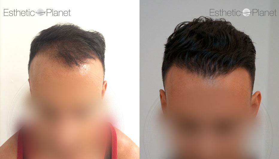 Before and after case 1 