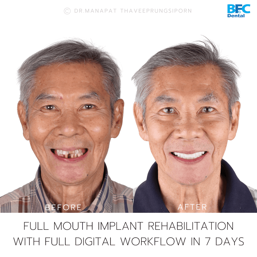 DENTAL ALL ON 4 case-1-1