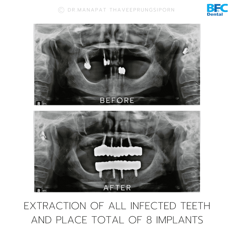 DENTAL ALL ON 4 case-1.2-1