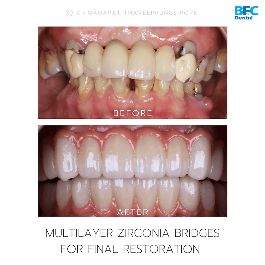DENTAL ALL ON 4 case-2.1-1