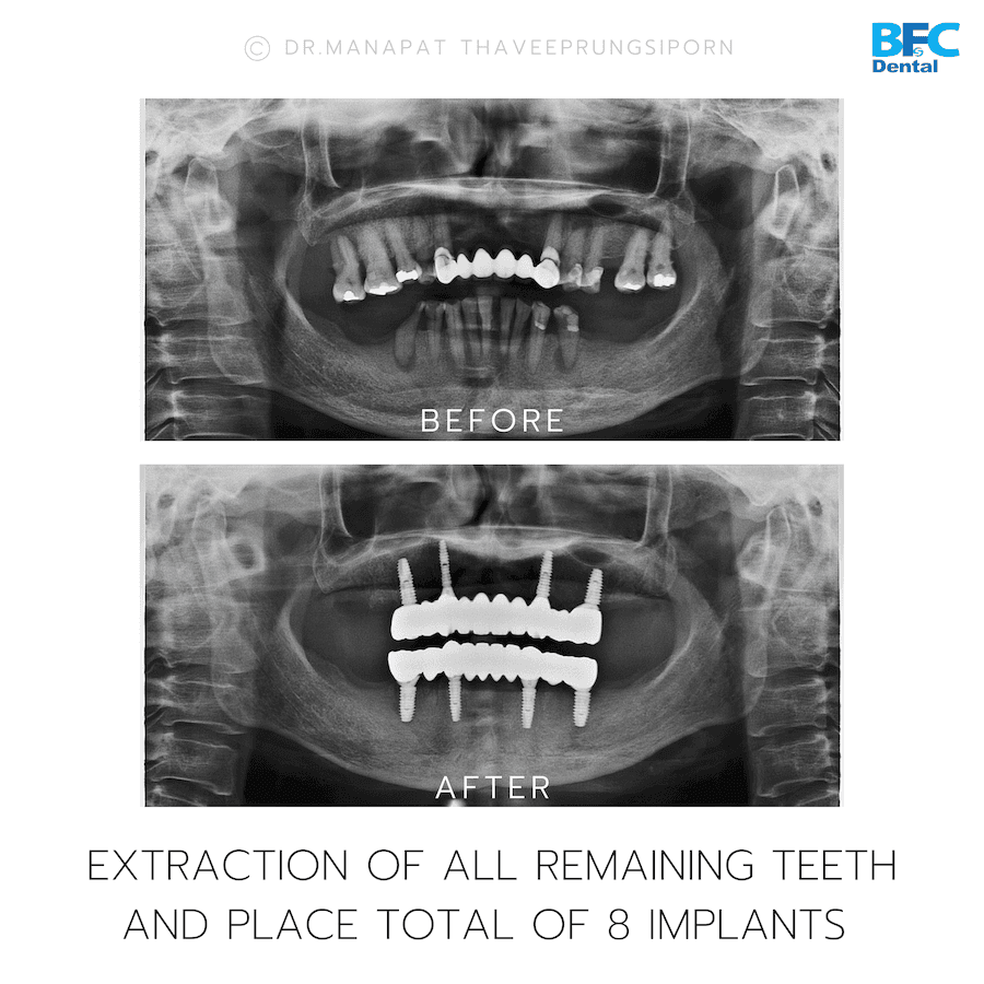 DENTAL ALL ON 4 case-2.2-1