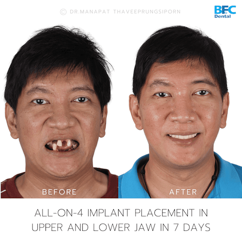 DENTAL ALL ON 4 case-3-1