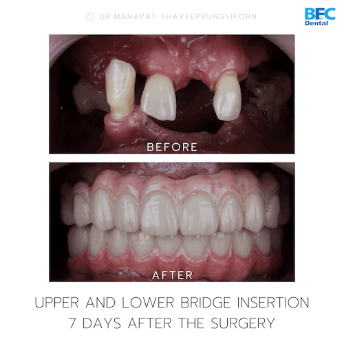 DENTAL ALL ON 4 case-3.1-1