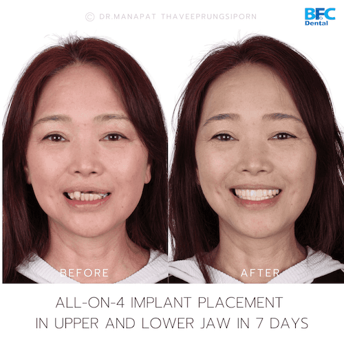 DENTAL ALL ON 4 case-6-1