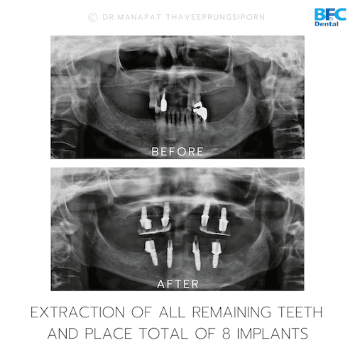 DENTAL ALL ON 4 case-6.2-1