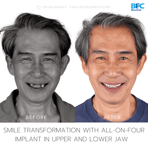 DENTAL ALL ON 4 case-7-1