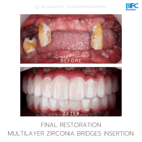DENTAL ALL ON 4 case-7.1-1
