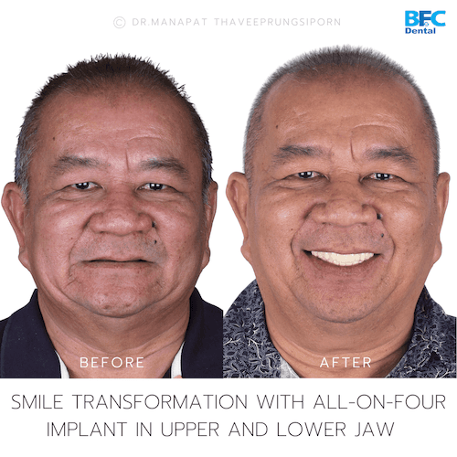 DENTAL ALL ON 4 case-9-1