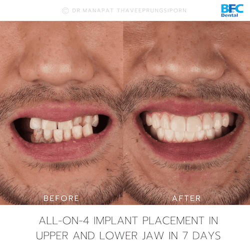 DENTAL ALL ON 4 case-12