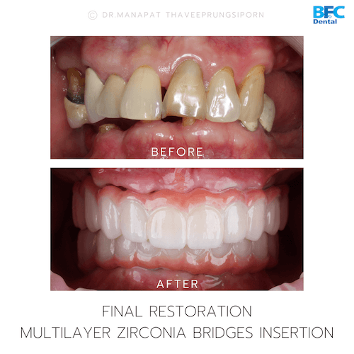 DENTAL ALL ON 4 case-1.1-1