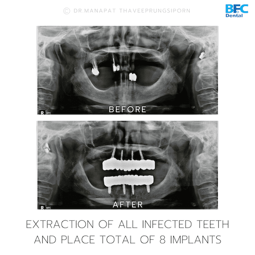 DENTAL ALL ON 4 case-1.2-1