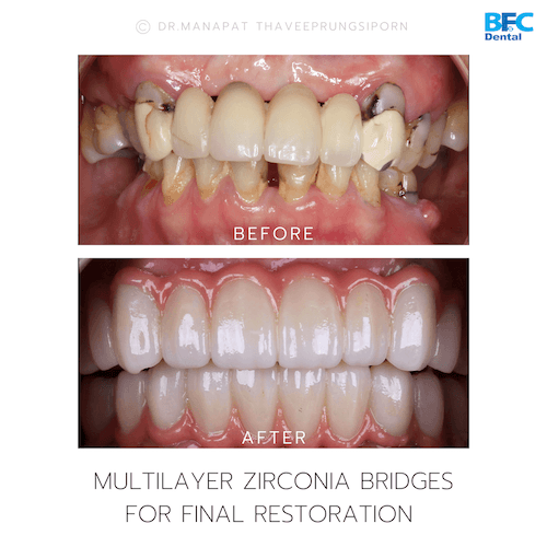 DENTAL ALL ON 4 case-2.1-1