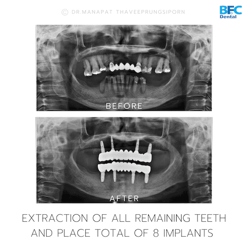 DENTAL ALL ON 4 case-2.2-1