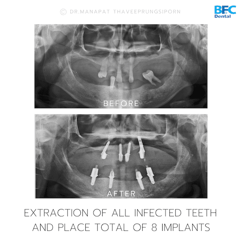 DENTAL ALL ON 4 case-3.2-1